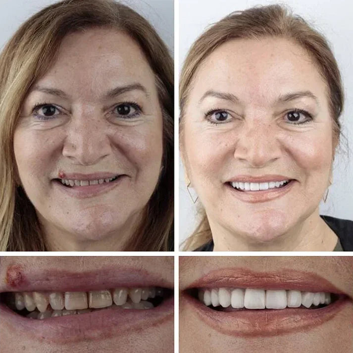 ⏰Ends Today: 50% OFF!  🏆2026 Bestselling Product🦷 Fit for a Fresh Smile, Say Goodbye to Wearing Discomfort!🌎