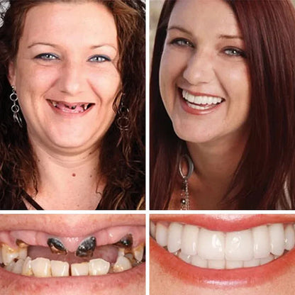 ⏰Ends Today: 50% OFF!  🏆2026 Bestselling Product🦷 Fit for a Fresh Smile, Say Goodbye to Wearing Discomfort!🌎