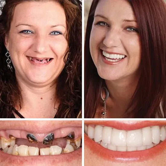 ⏰Ends Today: 50% OFF! 🌎KLENIMORE™ Custom-Fit — Designed for Comfort and a Natural-Looking Smile