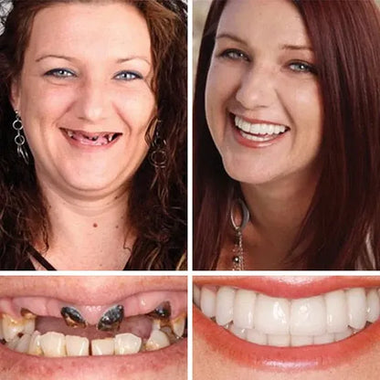 ⏰Ends Today: 50% OFF! 🌎KLENIMORE™ Custom-Fit — Designed for Comfort and a Natural-Looking Smile
